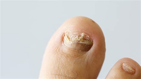 怎么治疗灰指甲最有效的（灰指甲长怎样、会传染？治疗灰指甲的药膏选择？5招预防） | 说明书网