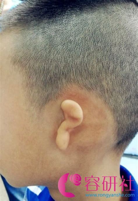 重庆大坪惠耳分享——不同年龄段选配助听器需要注意哪些事项？ - 知乎