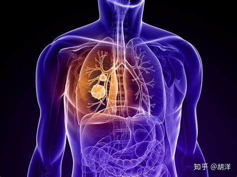 金发光教授：肺癌治疗中「光动力治疗」的作用主要应用于早期中央型肺癌根治治疗……浅谈指南对于PDT的推荐和变迁丨CACP 2022-头条-呼吸界