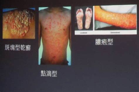 霉菌感染图片