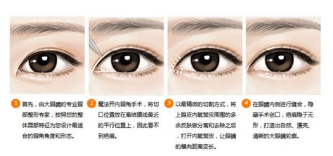 开内眼角与外眼角的区别及手术详解