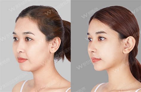 【图】韩式鼻子整形 让你拥有翘挺的鼻子_韩式鼻子整形_女物美容网|nvwu.com