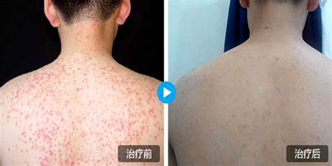 红疙瘩识别图片