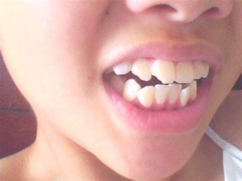 牙根纵裂必须拔掉吗?速看牙齿纵裂和横裂的区别是啥 - 口腔资讯 - 牙齿矫正网