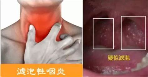 喉咙正常图片