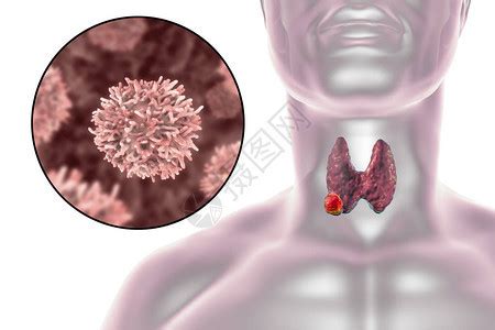 3D医疗图解显示一名妇女甲状腺癌图片素材-正版创意图片502662061-摄图网
