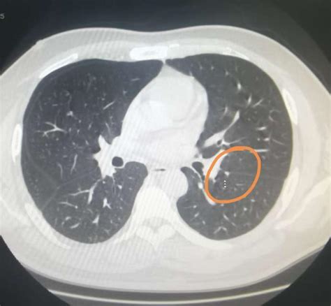 肺挫裂伤丨影像表现_医学界-助力医生临床决策和职业成长