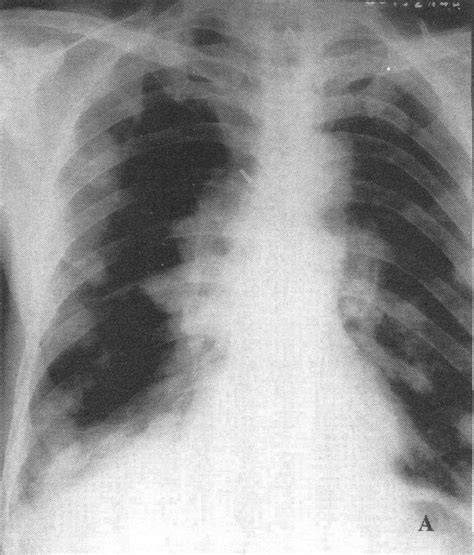 为什么肺癌一发现就是晚期？肺癌能在早期发现吗？_肿瘤_医生在线