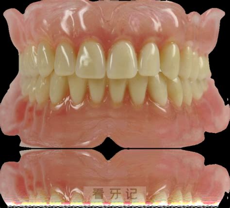 带你来了解什么是全口吸附性义齿？展示上海/北京装假牙价格 - 21怡口美牙网