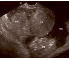 阴道超声诊断女性盆腔积液的半定量分析--中国期刊网