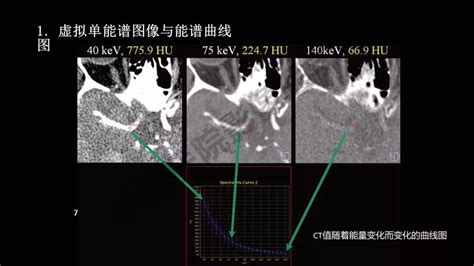 双源 CT 在泌尿系统结石分析中的应用 － 丁香园
