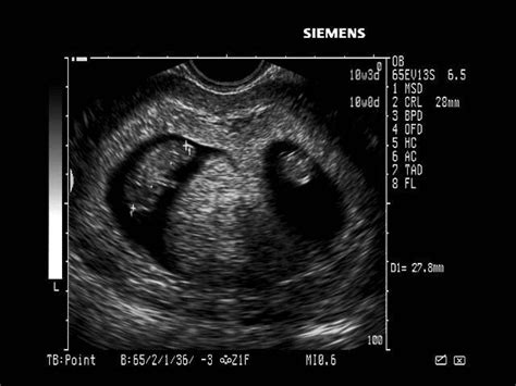 怀孕几周可以看到孕囊、胎心胎芽？|孕囊|怀孕|胎心_新浪新闻