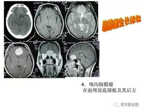 超全面颅脑肿瘤CT和MR诊断笔记_医学界-助力医生临床决策和职业成长