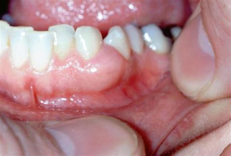 牙龈增生图片_牙龈增生症状表现图片大全_有来医生