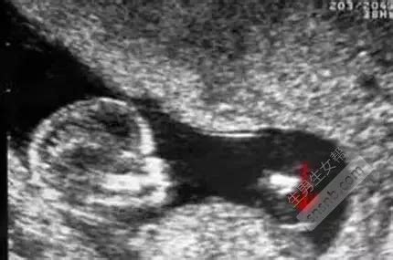 如何从妇科B超报告看输卵管/盆腔的情况？ - 知乎