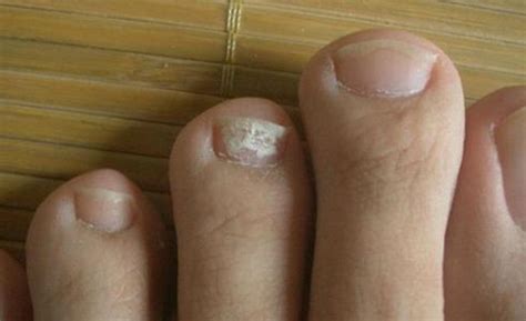 大脚趾灰指甲的初期症状图片_有来医生