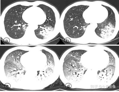 新冠肺炎诊断标准之争：CT影像还是核酸检测？ - 知乎