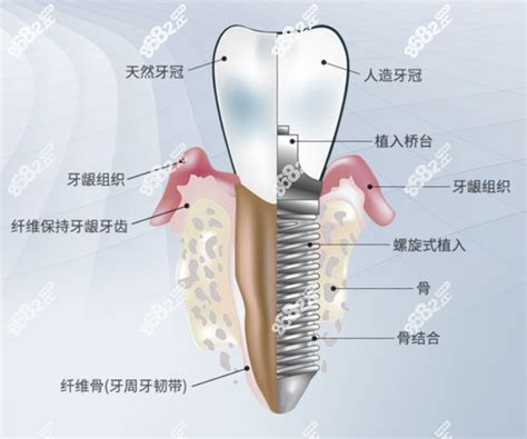 巴中种植牙的价格表，看巴中做全口/半口/一颗种植牙多少钱,牙齿对比照片-8682赴韩整形网