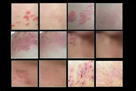 外阴溃烂图片