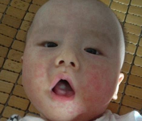 宝宝花粉过敏症状有哪些 盘点宝宝点花粉过敏的三种表现_过敏_快速问医生