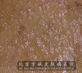 毛发红糠疹图片