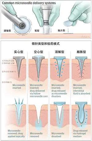 富血小板血浆（PRP）技术--广州中兴运动损伤专科医院有限公司