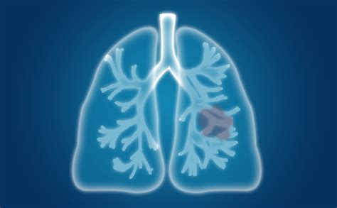 如何判断肺癌已经到了中期？依据是什么？_肿瘤_医生在线