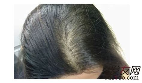 七大方法解决脱发导致头发稀疏问题 总有一种方法适合你 - 热点资讯 - 毛毛网