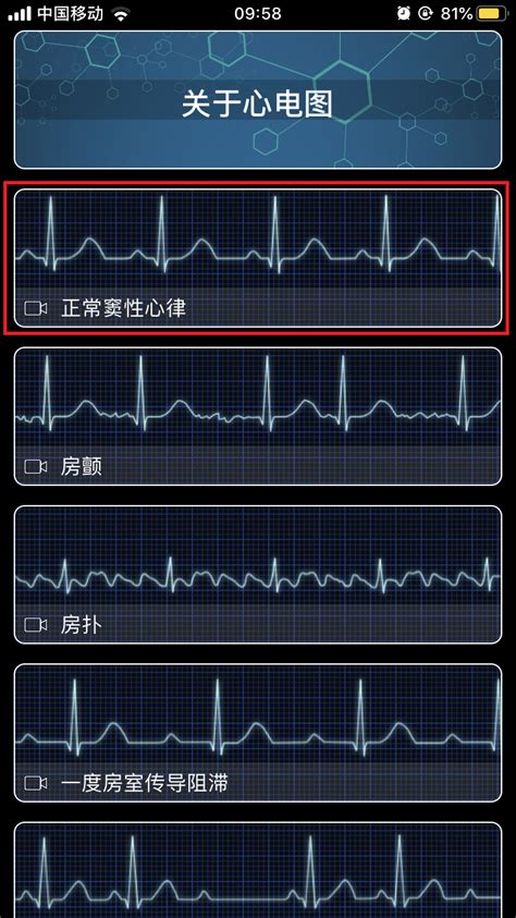 正常的心率图的波形,正常的心率曲线图,正常心率图_大山谷图库