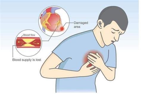 心肌梗塞到来之前，身体的5个地方会出现疼痛，别不当回事！|心肌梗塞|症状|心脏_新浪新闻