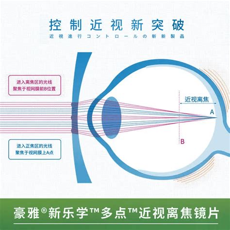 多点近视离焦镜片预防近视的优缺点_青少年_控制_眼镜