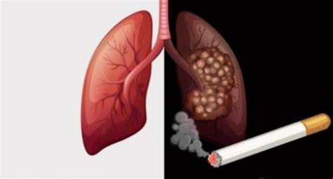 【科普】怎么能早期发现肺癌