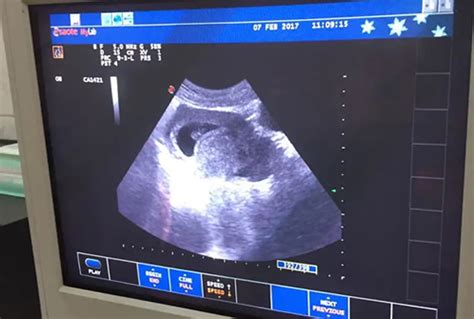 b超描述：子宫后位，如孕50+天大，宫区回声均匀，宫腔内见胚芽22*22*13mm,囊内见卵巢及胚芽，芽长11mm - 百度宝宝知道