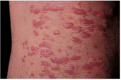 红色斑丘疹的预防与治疗-色斑治疗-复禾健康
