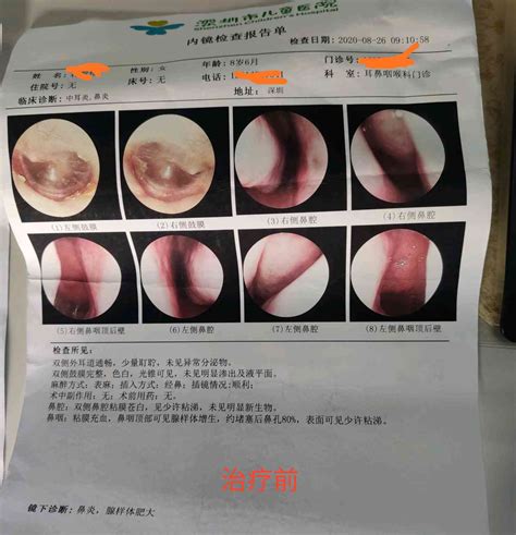 鼻甲肥大的图片