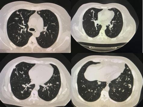 查出肺结节，可以根据4个“特征”判断肺结节良恶性，良性别担心
