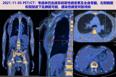 背部长瘤大全图片