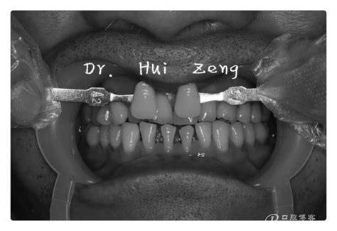 微创美学仿生前牙树脂修复之形与色——曾辉(原创）-牙医小灰灰曾辉的博客-KQ88口腔博客