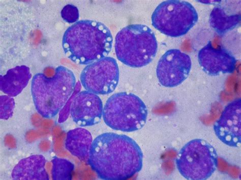 淋巴细胞丰富型经典型霍奇金淋巴瘤
