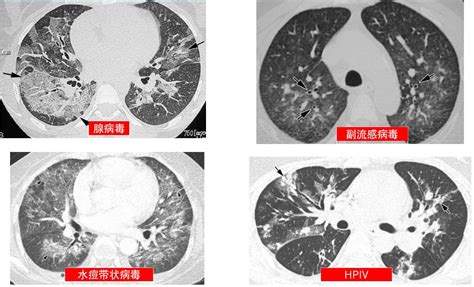 实践技能辅助检查之普通X线影像诊断（二）肺炎