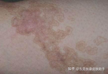 身上皮肤长癣的图片-中华银屑病网