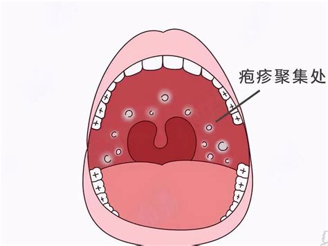 腭咽弓发炎图片