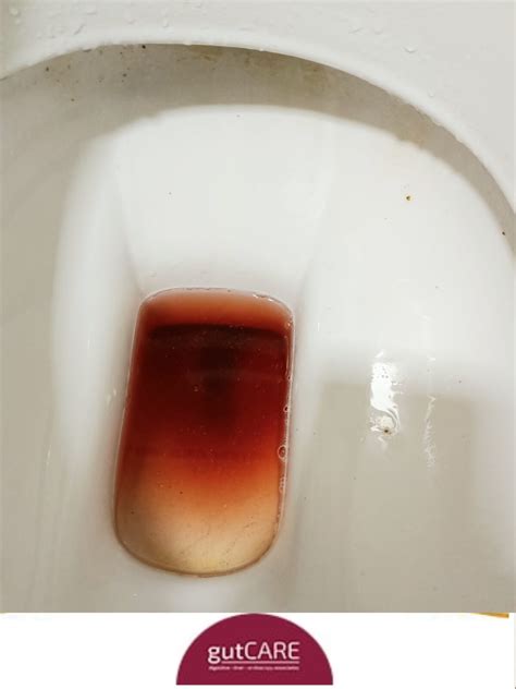 暗红色便血图片