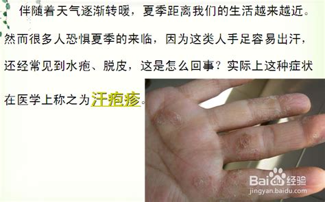 手指汗疱疹怎么治疗最有效（夏季是"汗疱疹"高发季节，手上出现密密麻麻小水泡，该怎么办？） | 说明书网