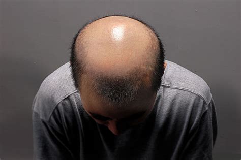 英国秃头法官裁定，称男人是“秃头”算性骚扰！ - 知乎