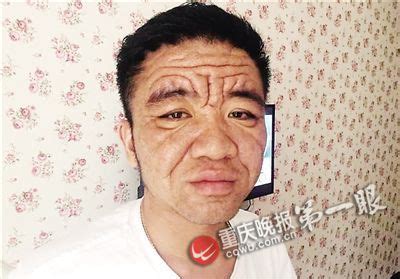 30岁男子满脸皱纹状如80岁老头 全身肿带浓(图)--图片频道--人民网