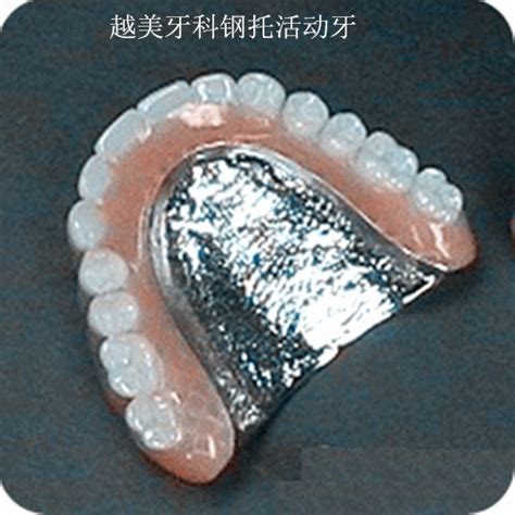 纯钛支架活动义齿,钴铬,氧化_大山谷图库