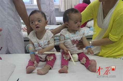 现实版胡巴女孩：双胞胎姐妹同患罕见病 呼吁爱心人士救助_郑州仁济医院