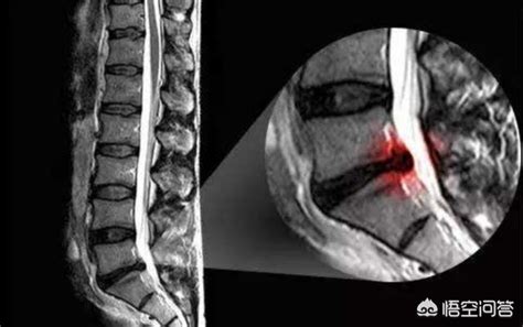 磁共振脊柱规范扫描及技术应用（腰椎部分） - 知乎