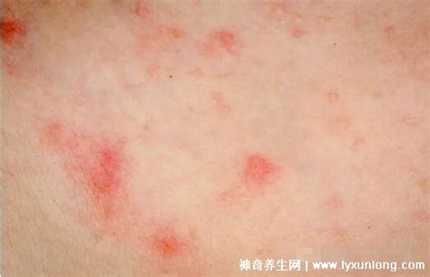 过敏性皮炎图片和症状，表现为湿疹/荨麻疹/各种皮炎(红肿瘙痒) — 神奇养生网